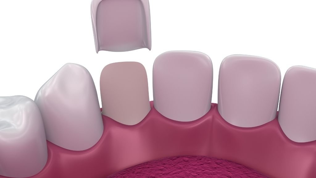 Carillas de Composite