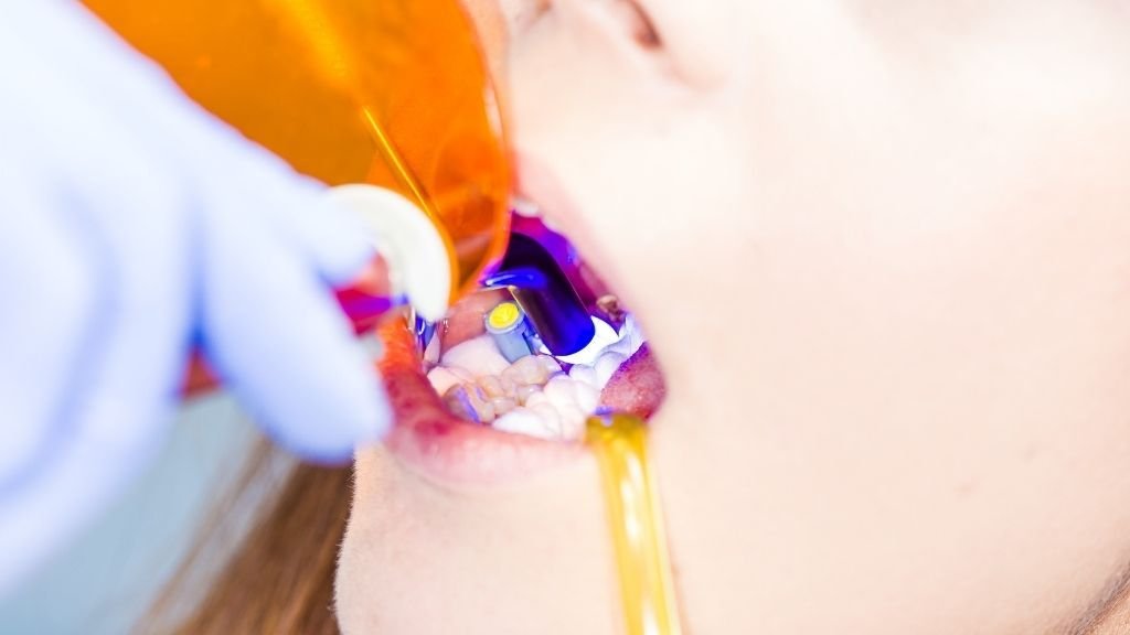 Sellando una pulpotomía en niños