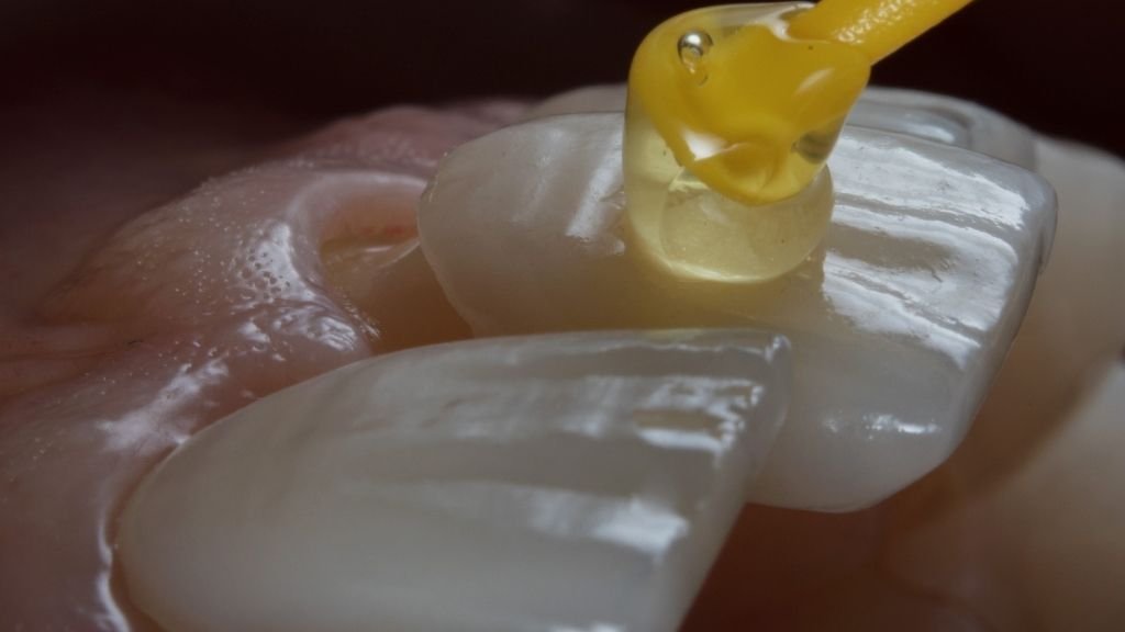 Carillas de Porcelana colocación