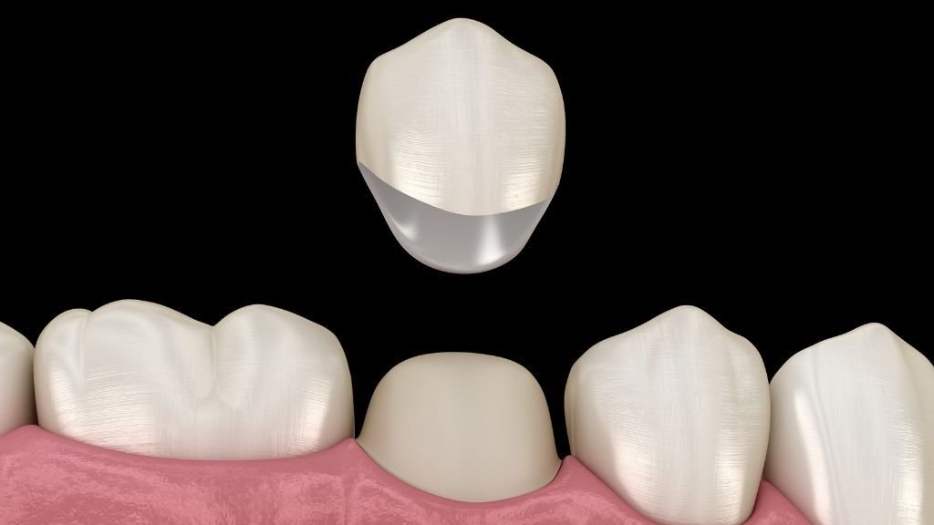 Alargamiento coronario, corona