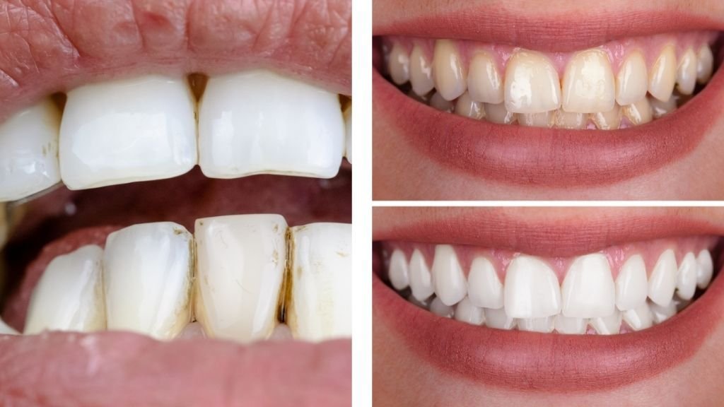 Manchas en los dientes antes y después