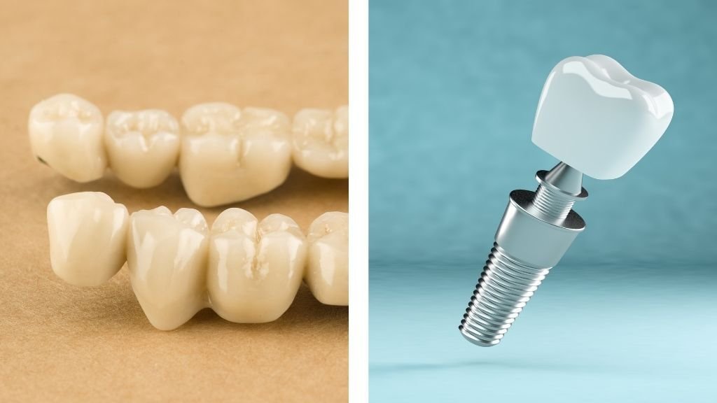 Puente dental o implante