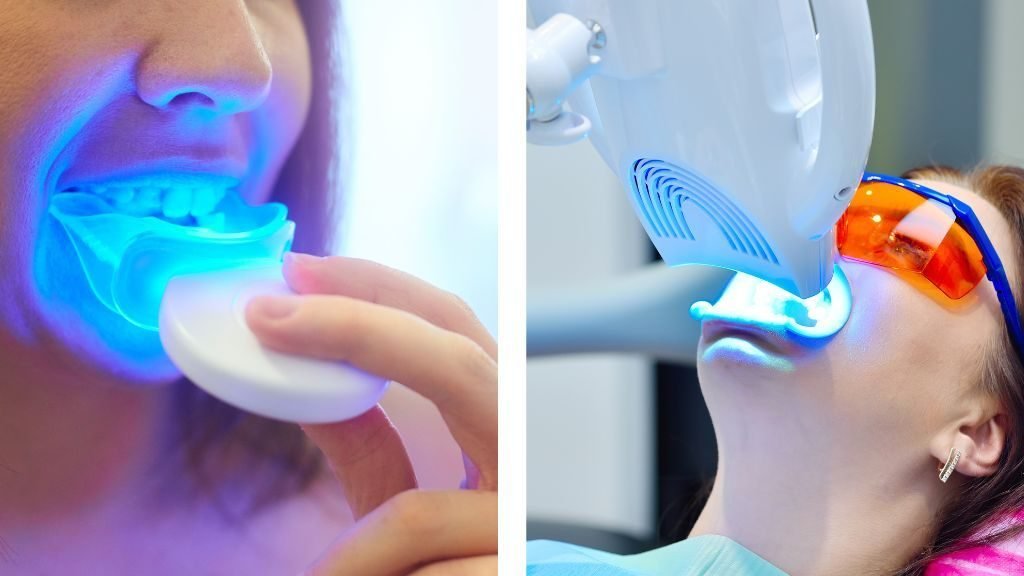 Blanqueamiento dental en casa o en clínica
