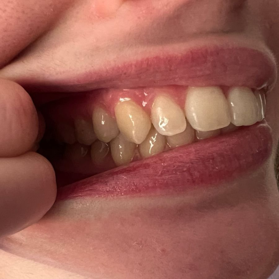 right side of the teeth