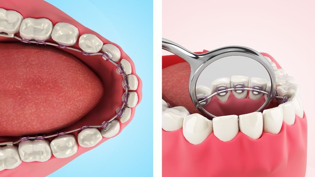 Cómo son los brackets linguales