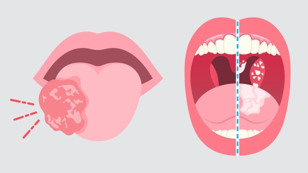 Llaga en la lengua sana y llaga en la lengua curada
