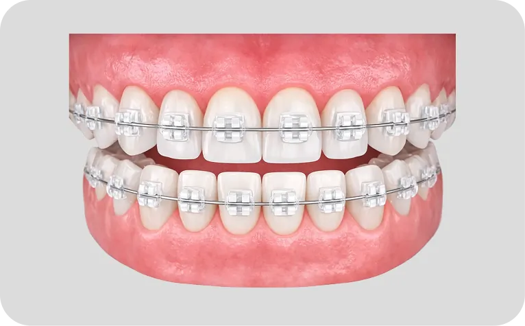 Brackets en Alicante