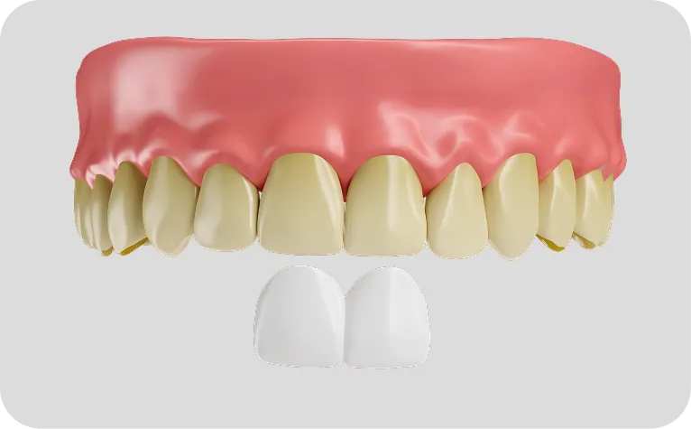 carillas dentales en Alicante