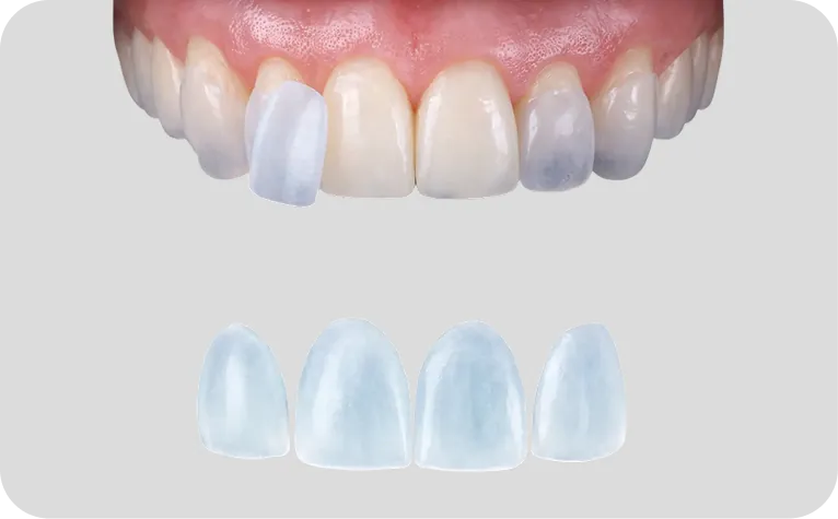 carillas dentales en Alicante