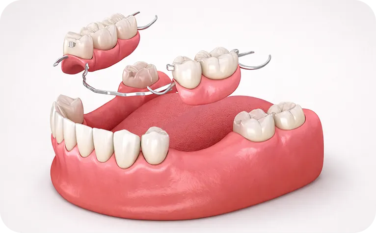 Prótesis dental en Alicante