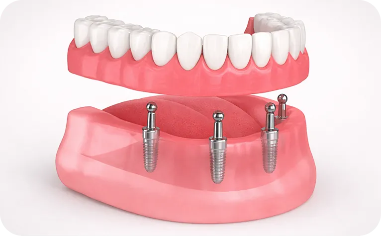 Prótesis dental en Alicante