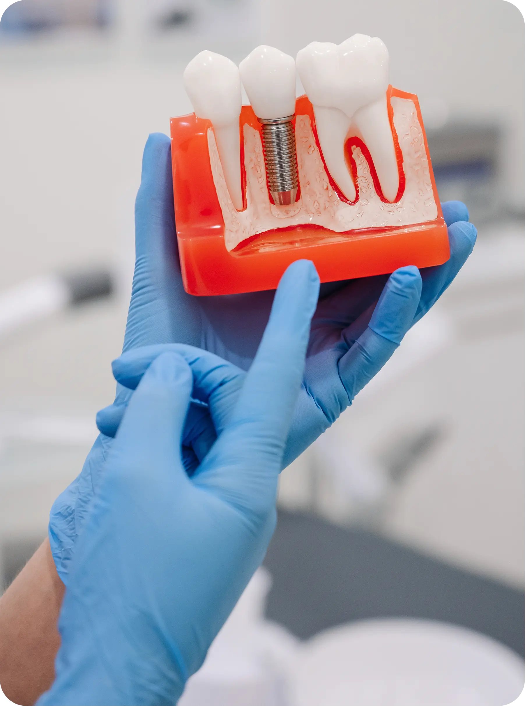 Implantes dentales en Alicante