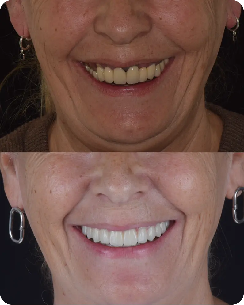 Caso real 1: antes y después del tratamiento dental