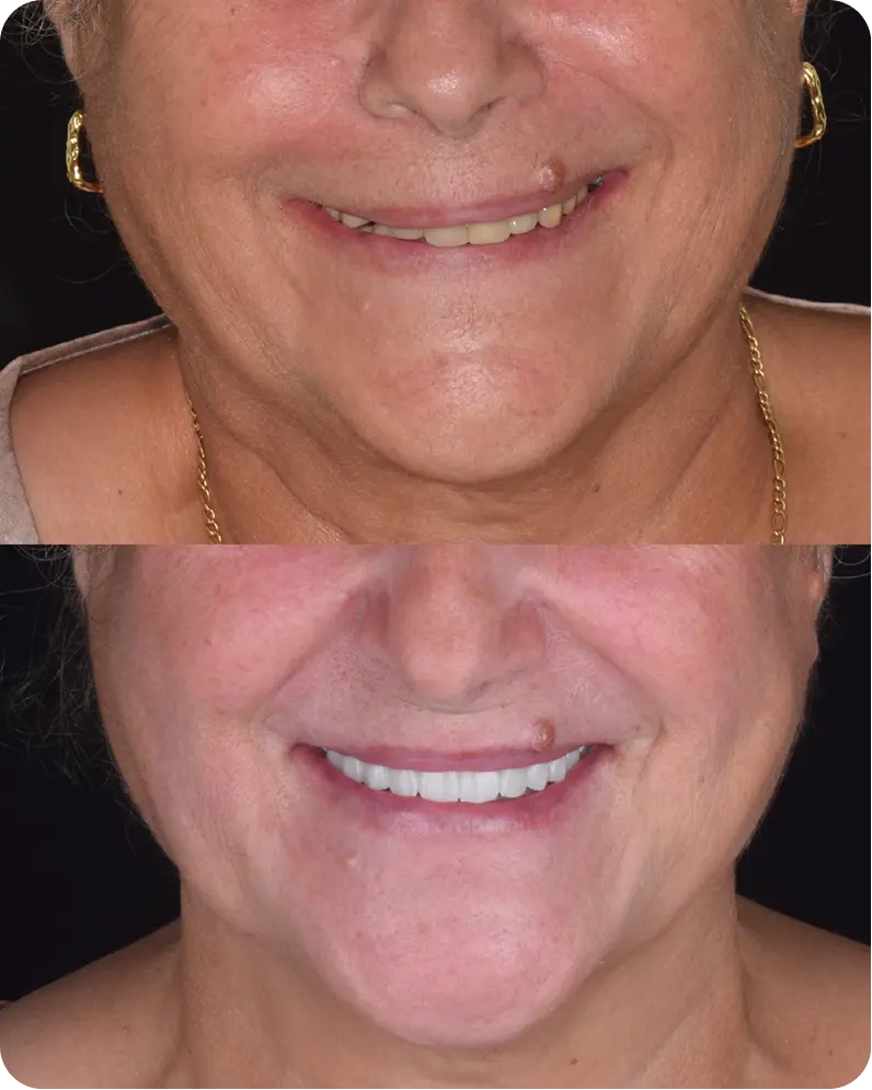 Caso real 2: antes y después del tratamiento dental