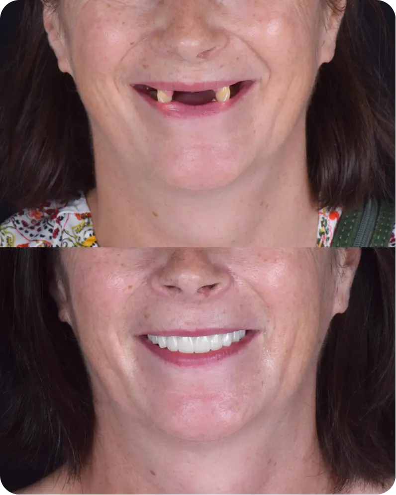 Caso real 3: antes y después del tratamiento dental